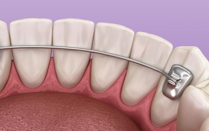 Maintaining Your Fixed Lingual Retainer Tips and Removal Criteria